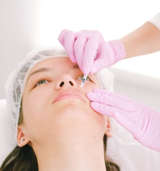 nasal fold filler